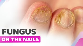 Fungus on the Nails  Koilonychia  Manicure and Fungus Cleanup [upl. by Nnayelsel]