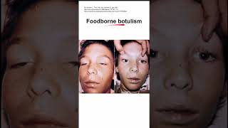 Foodborne botulism [upl. by Yesima]