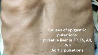 Epigastric pulsation Department of Medicine DMIHER [upl. by Josias]