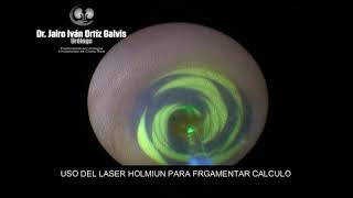 LITOTRICIA LASER EN CALCULO URETERA IZQUIERDO [upl. by Verdha]