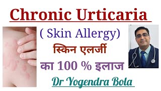 Chronic Urticaria Skin Allergy के कारण and Complete Treatment in Hindi [upl. by Okimat]