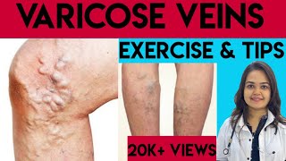 Varicose veins treatment in Hindi English subtitles Exercises and tips  Yoga for varicose veins [upl. by Irpak313]