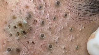 Big Cystic Acne Blackheads Extraction Blackheads amp Milia Whiteheads Removal Pimple Popping  8272 [upl. by Eynahpets911]