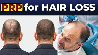 PRP Treatment For Hair Loss  Therapy Result  Skin Doctor Podcast  Click Entertainment [upl. by Aipotu441]