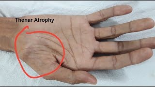 Thenar Atrophy in Motor Neuron Disease [upl. by Digirb]