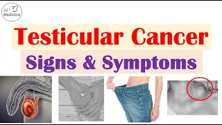 Testicular Cancer Signs and Symptoms Risk Factors amp Metastases [upl. by Leunam]