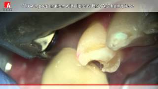 Crown Preperation Fotona Lightwalker ErYAG Laser [upl. by Jed]