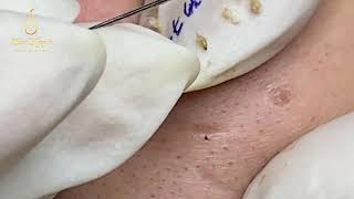 BLACKHEADS EXTRACT 71  Loan Nguyen [upl. by Durr]