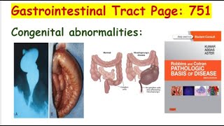 CONGENITAL ABNORMALITIES OF THE GIT lecture 2 ROBBINS AND COTRAN [upl. by Christal]