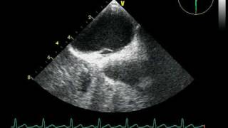 PFO  PATENT FORAMEN OVALE TOE  Foramen oval permeable ETO echocardiography [upl. by Wylde984]