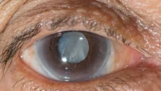 New eye drops may help treat cataracts [upl. by Anelis]