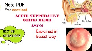 Acute Suppurative Otitis Media  ASOM  ENT  Easy explanation  Stages  Diagnosis  Management [upl. by Syverson]