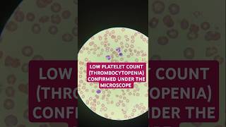 Thrombocytopenia low platelet confirmed under the microscope thrombocytopenia plateletcount [upl. by Wynnie]