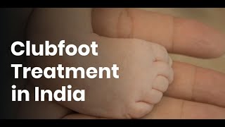 Clubfoot Treatment in India  Clubfoot Treatment Cost in India [upl. by Artened]