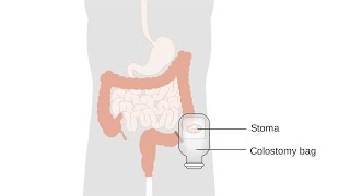 colostomy ASL [upl. by Terri]