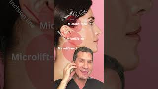 Microlift vs Endoscopic facelift What are the differences [upl. by Galan]