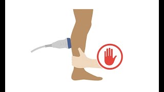 Venous ultrasound class Interpreting DVT compressibility and chronicity on ultrasound [upl. by Jacoba170]