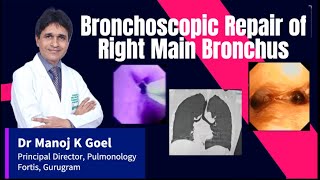 Bronchoscopic Dilatation Bronchial Stenosis Dr MANOJ GOEL lungcancer tuberculosis bronchoscopy [upl. by Moia517]