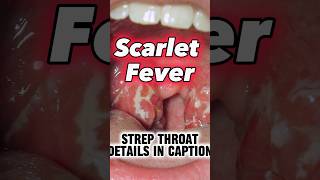 👀What Does Strep Throat Rash Look Like Scarlet Fever Scarlatina [upl. by Aubigny935]