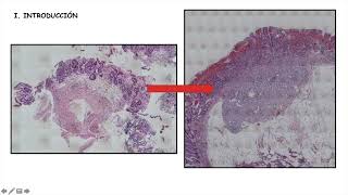 Sesión Hiperplasia de células neuroendocrinas gástricas [upl. by Loretta]