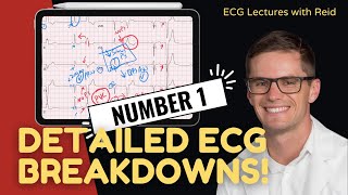 EKG Test Yourself  ECG Case Study 1 [upl. by Earahs]