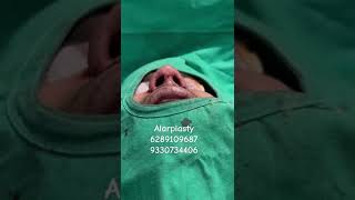 ALARPLASTYdranirbanghoshnosefillervasergynecomastiaaestheticsurgerynosejobs [upl. by Ellga877]