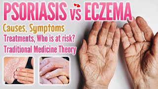 Psoriasis vs eczema causes symptoms treatment traditional medicine theory comparison [upl. by Martel]