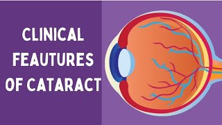 Clinical feautures of Cataract  Ophthalmology  NEETPG [upl. by Schach]