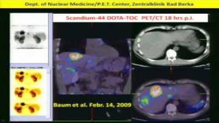 Neuroendocrine Tumors Diagnosis amp Treatment w Peptide Receptor RadiotherapyPRRT Dr Baum 2of2 [upl. by Ymorej]