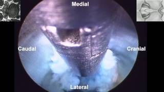 Percutaneous Endoscopic Interlaminar Lumbar Discectomy PEILD by Dr Hyeun Sung Kim01 [upl. by Yruam]