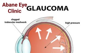 Know More About GLAUCOMA [upl. by Haimorej]