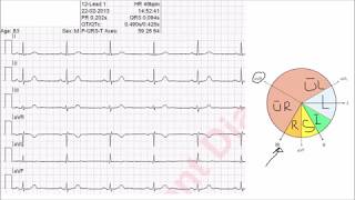 Bestimmung des Lagetyps vereinfachte Methode mit Tabelle oder Cabrera Kreis [upl. by Attayek698]