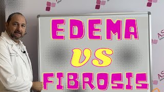 Edema VS Fibrosis Whats the Difference Liposuction Contour Irregularity  Lipo Lumps and Bumps [upl. by Derman995]