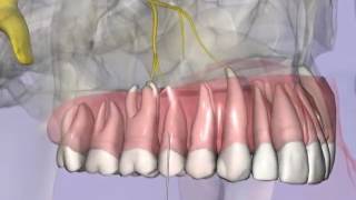 maxillary infiltrationmp4 [upl. by Neersin97]