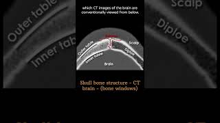 Skull bone structure 2 CT Brain Anatomy Skull Bones amp Sutures radiologychannel007 [upl. by Ahsikat692]