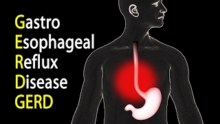 Gastro Esophageal Reflux Disease Update Vlog Style [upl. by Romine]