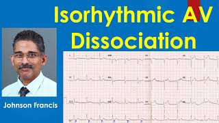 Isorhythmic AV Dissociation [upl. by Kresic]