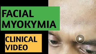 Facial myokymia vs hemifacial spasm clinical video [upl. by Enyad58]