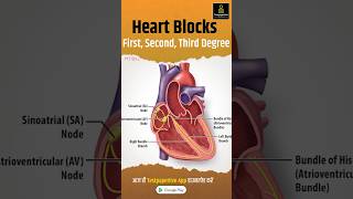 Heart Blocks Explained  First Second Third Degree heartblocks ecg heart shorts block ekg [upl. by Eilegna258]