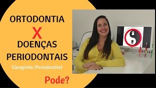 Ortodontia X Doenças Periodontais [upl. by Kalina713]