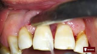 Advanced periodontal disease [upl. by Coletta]