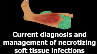 Current diagnosis and management of necrotizing soft tissue infections [upl. by Harlamert]