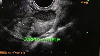 Corpus luteum with peripheral ring of fire USG U ltrasound [upl. by Auot]