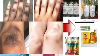 How to Use Piment Doux  any of this to Clear Dark Knees and Brighten Your Knuckles in 5 Days [upl. by Gader]