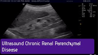 Ultrasound  How to Diagnose Chronic Renal Parenchymal Disease [upl. by Assirrec]