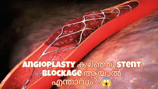 Angioplasty കഴിഞ്ഞു stent അടഞ്ഞു പോലോ 🥹 [upl. by Risteau]