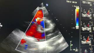 Gerbode defect isolated [upl. by Acinahs]