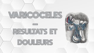 LES VARICOCÈLES  DOULEURS ET RESULTATS [upl. by Hamford305]