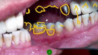 Edident Lab quotDental Upper six unit Porcelain Buildup Part 1quot [upl. by Valery]