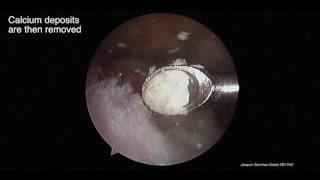 Arthroscopic removal calcific tendonitis [upl. by Bordy]